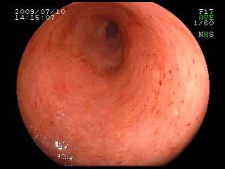 当院における潰瘍性大腸炎の臨床像（1）