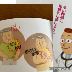 ピリピリ痛と小さい水疱には要注意⚠️